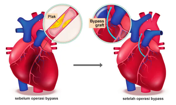 Inilah Bayangan Biaya Operasi Jantung Bypass